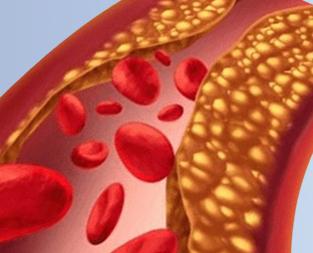 blog//high-cholesterol-levels