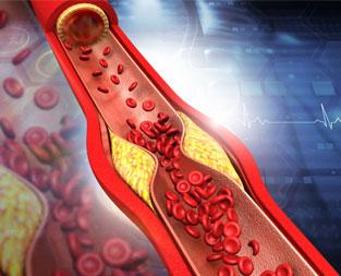 blog//what-is-ldl-cholesterol-in-a-blood-test